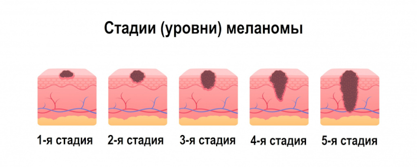 стадии меланомы