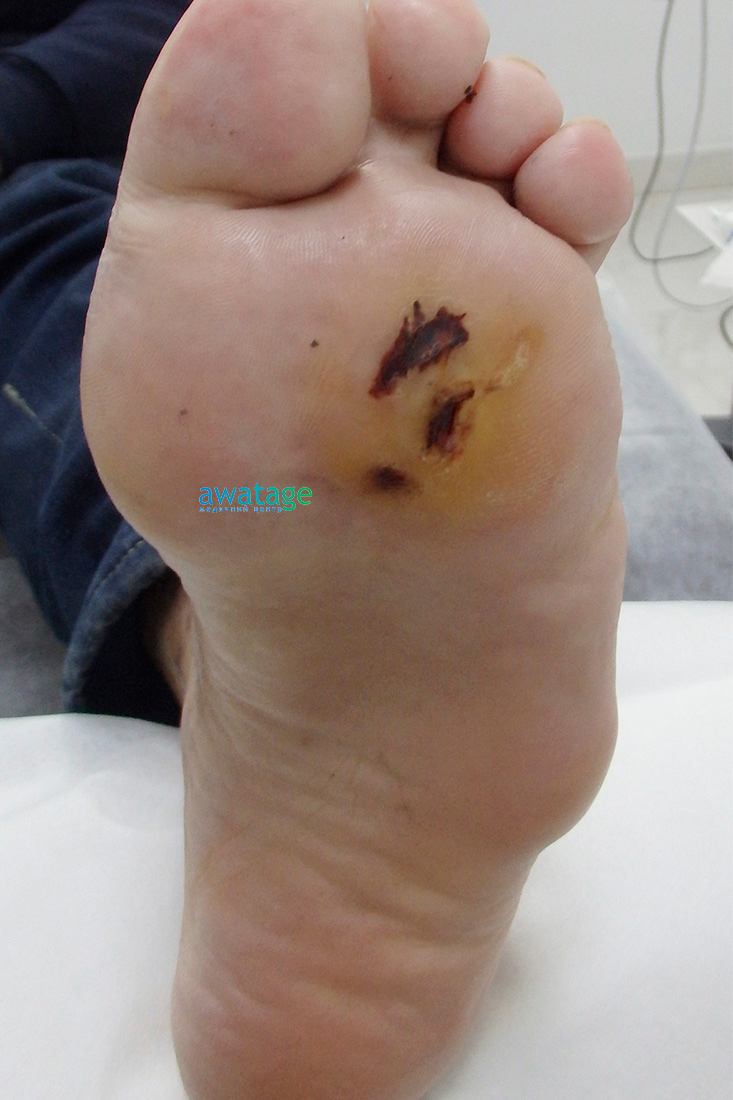 лечение диабетической стопы в Киеве